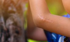 Cicatrici addio.  Dai tutori compressivi ai cerotti al silicone: le terapie
