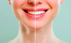 Denti bianchi, come avere un sorriso perfetto