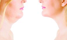 Doppio mento addio:  rimedi  &laquo;soft&raquo; e chirurgia