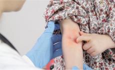 Dermatite atopica: problema comune tra i bimbi