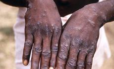 Oms: il vaiolo delle scimmie è un'emergenza sanitaria globale. Primi 2 casi registrati in provincia di Cremona
