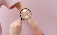 Melanoma, in Italia +7% casi l'anno, fondamentale la  prevenzione. Stanganelli: "Fate almeno un controllo all'anno"