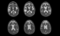 Stati Uniti, la Fda autorizza un atteso farmaco contro l'Alzheimer 