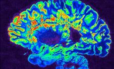 Sclerosi multipla, trovato marcatore che predice disabilita'