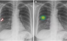 L'Ai svela i non fumatori a rischio di cancro ai polmoni