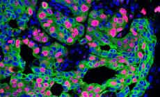 Scoperto perch&eacute; lo stress alimenta la diffusione dei tumori