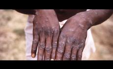 Vaiolo delle scimmie, sette persone contagiate in Friuli