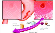 Asma, tosse e denti rovinati? Può essere il reflusso gastroesofageo