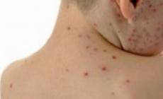 Morbillo: 864 casi da inizio anno, il picco ad aprile