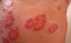 Tre ragazzi con la scabbia alle superiori