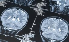 Tumori cervello, un software 'bravo' come i medici nella  diagnosi