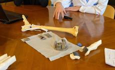 Caviglia ricostruita in 3D al Rizzoli di Bologna: è prima volta al mondo 