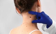 Tieni d'occhio i nei,  come riconoscere quelli sospetti