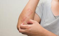 Psoriasi, un nuovo farmaco ottiene la rimborsabilità dall'Aifa