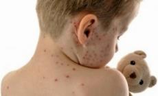 Metà degli italiani teme i vaccini. E il morbillo impazza