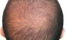 Ecco la pillola anzi-calvizie, chioma ricresce in 4 mesi 