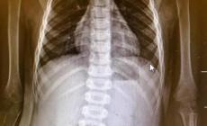 Ingoia una moneta, salvato un bimbo di 3 anni