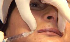 Botox contro la depressione
