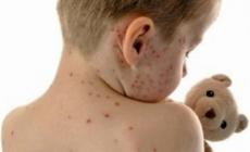 Morbillo: anche a Parma casi in aumento