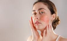 Pelle in fiamme? Può essere  orticaria 