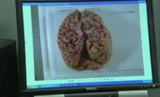 Alzheimer: tecnica a ultrasuoni per ripristinare la memoria