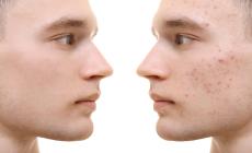 Una pelle a pois. Acne e brufoli: cosa fare