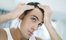 La calvizie cause e soluzioni                             