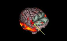 Riabilitazione dell'ictus, al via uno studio parmigiano tra realtà virtuale e neuroni specchio