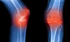 Stop osteoporosi: salva le tue ossa  