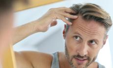 Calvizie, 5 motivi per i quali l&rsquo;uomo perde i capelli