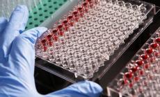Mieloma multiplo: una ricerca dell’università di Parma suggerisce una nuova via per prevenire le lesioni ossee