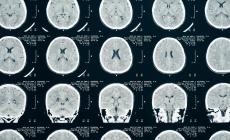 Un esame del sangue salvavita entro 1 ora da trauma cerebrale