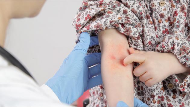 Dermatite atopica: problema comune tra i bimbi
