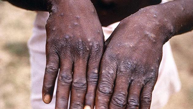 Vaiolo scimmie: Asl, ad Arezzo primo caso in Toscana  