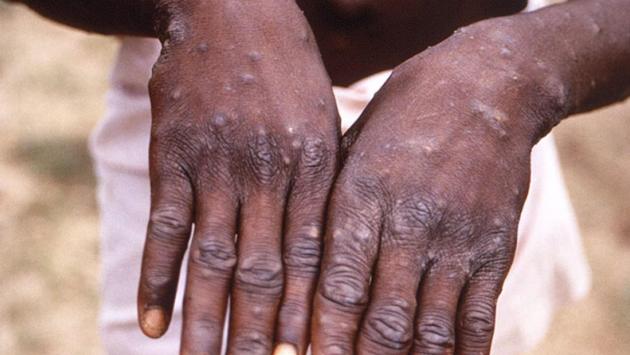 Vaiolo delle scimmie: isolato il virus al Sacco di Milano 