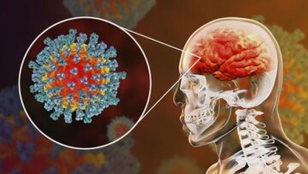 Nebbia nel cervello, sintomo simile a Alzheimer