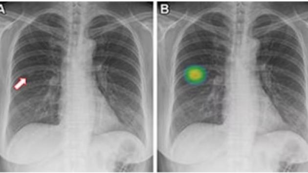 L'Ai svela i non fumatori a rischio di cancro ai polmoni