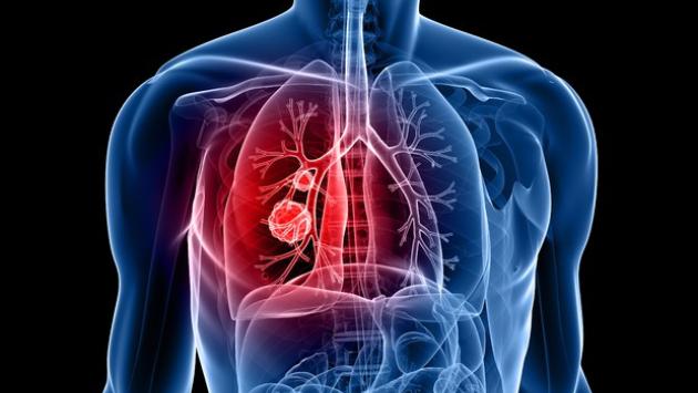 In Gb sperimentazione sul vaccino contro il cancro ai polmoni