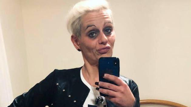 Aggredito con acido dalla ex, condizioni in miglioramento