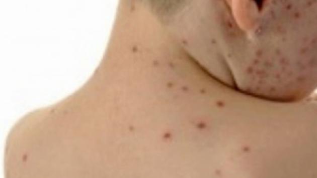 Morbillo: 864 casi da inizio anno, il picco ad aprile