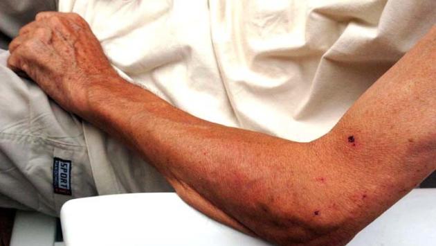 Allarme zanzare. I consigli per evitare punture e malattie 