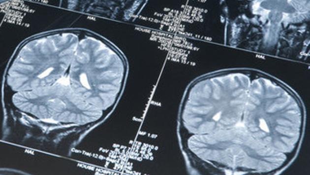 Tumori cervello, un software 'bravo' come i medici nella  diagnosi