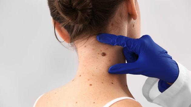 Tieni d'occhio i nei,  come riconoscere quelli sospetti