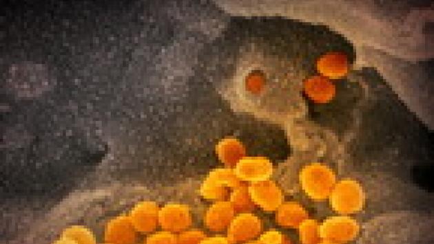 Coronavirus, il mix di antivirali per l'Aids fallisce