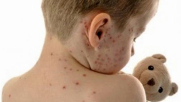 Morbillo: a Parma colpiti soprattutto gli adulti