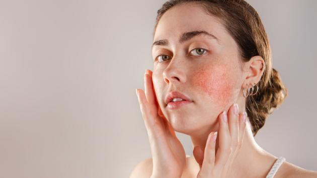 Pelle in fiamme? Può essere  orticaria 