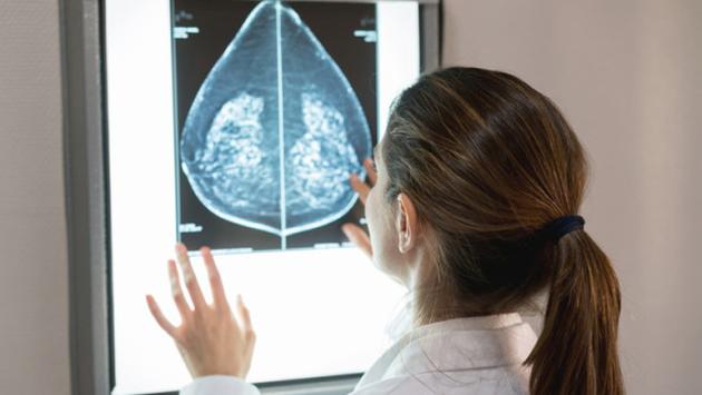 Tumore al seno, terapia mirata allunga la vita