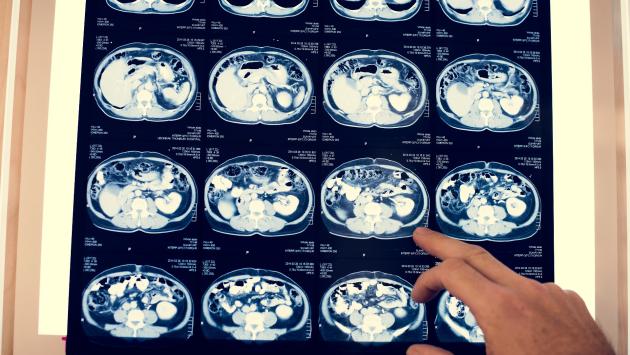 Tumori: un nuovo protocollo riduce fino a al 50% i giorni di ricovero
