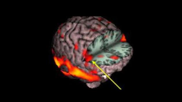Riabilitazione dell'ictus, al via uno studio parmigiano tra realtà virtuale e neuroni specchio
