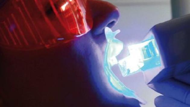 Con lo sbiancamento dentale torna il piacere di sorridere